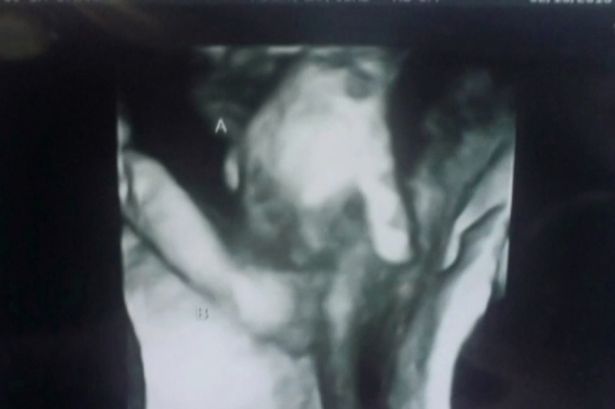 Kui tavaliselt kaksikud ultraheli fotosid tehes põksivad ja trügivad üksteist, siis need kaksikud pigem hoidsid ja kaitsesid teineteist. Nad hoidsid lausa käest kinni. Nimelt tuvastasid arstid, et kaksikutest poiss ei jää elama, kuna ta südames on auk ning aju on kahjustatud. Vanemate ainuke lohutus ongi see ultraheli foto, kus õde hoiab oma haiget venda käest, nagu lohutades, et kõik saab korda...