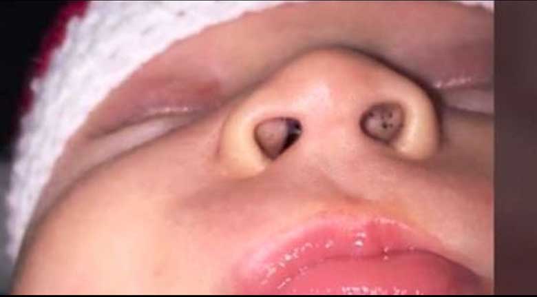 HOIATUS KÕIGILE eriti talvel - EMA MÄRKAS lapse ninas musti täppe, mis on väga ohtlik märk